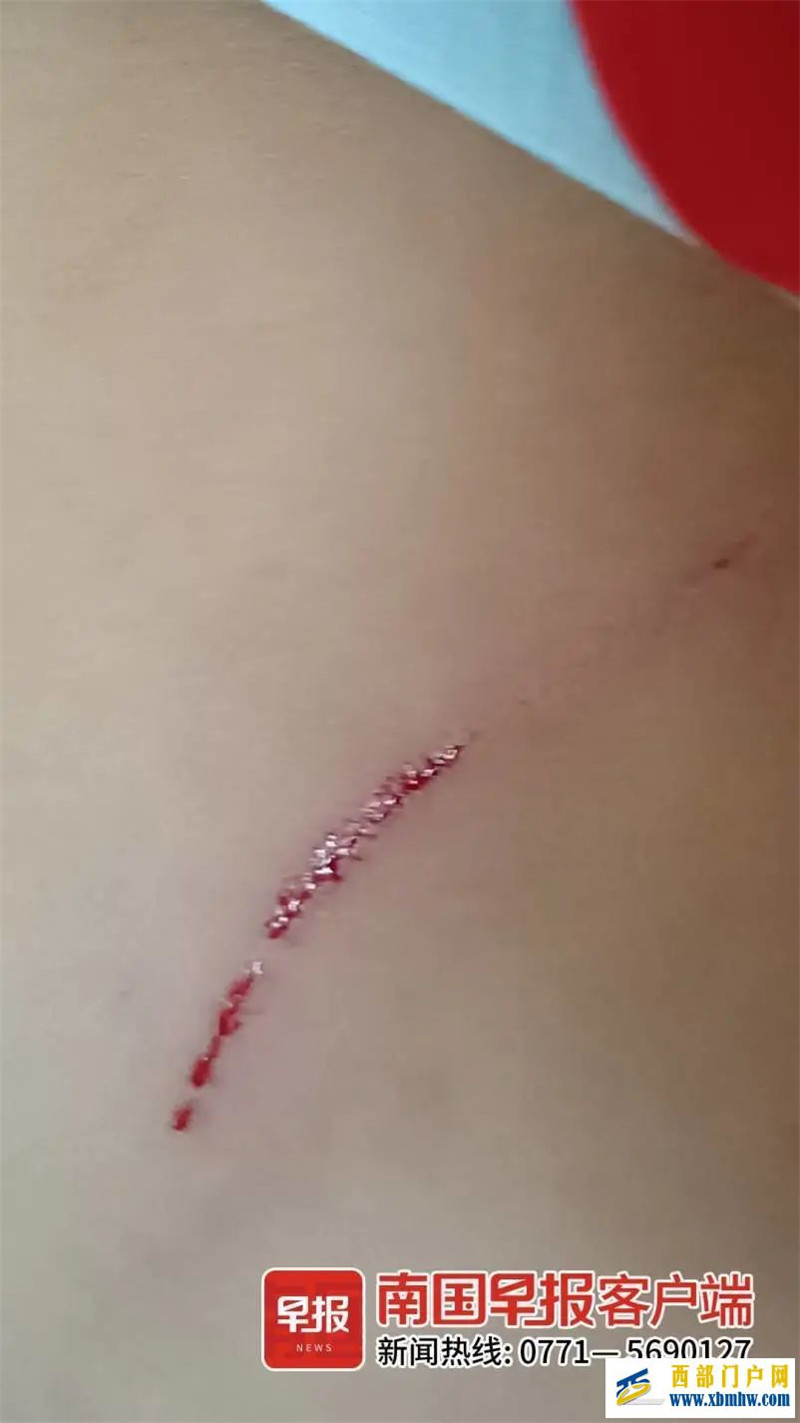 南宁一女孩背部遭受重击,家长急寻目击者(图1) 南宁一女孩背部遭受重击,家长急寻目击者(图1)